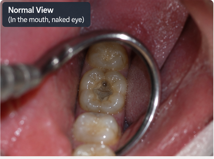Tooth seen with naked eye